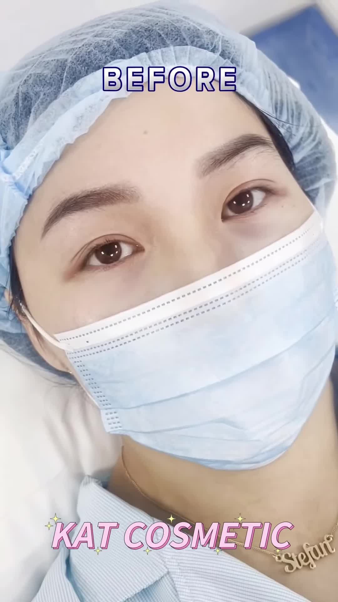 BẤM MÍ : Sự lựa chọn hoàn hảo cho các những bạn có đôi mắt không đều,  có ít da dư và mỡ thừa, những cô nàng mắt một mí, nhiều mí lót nhưng vẫn muốn sở hữu đôi mắt hai mí to tròn.